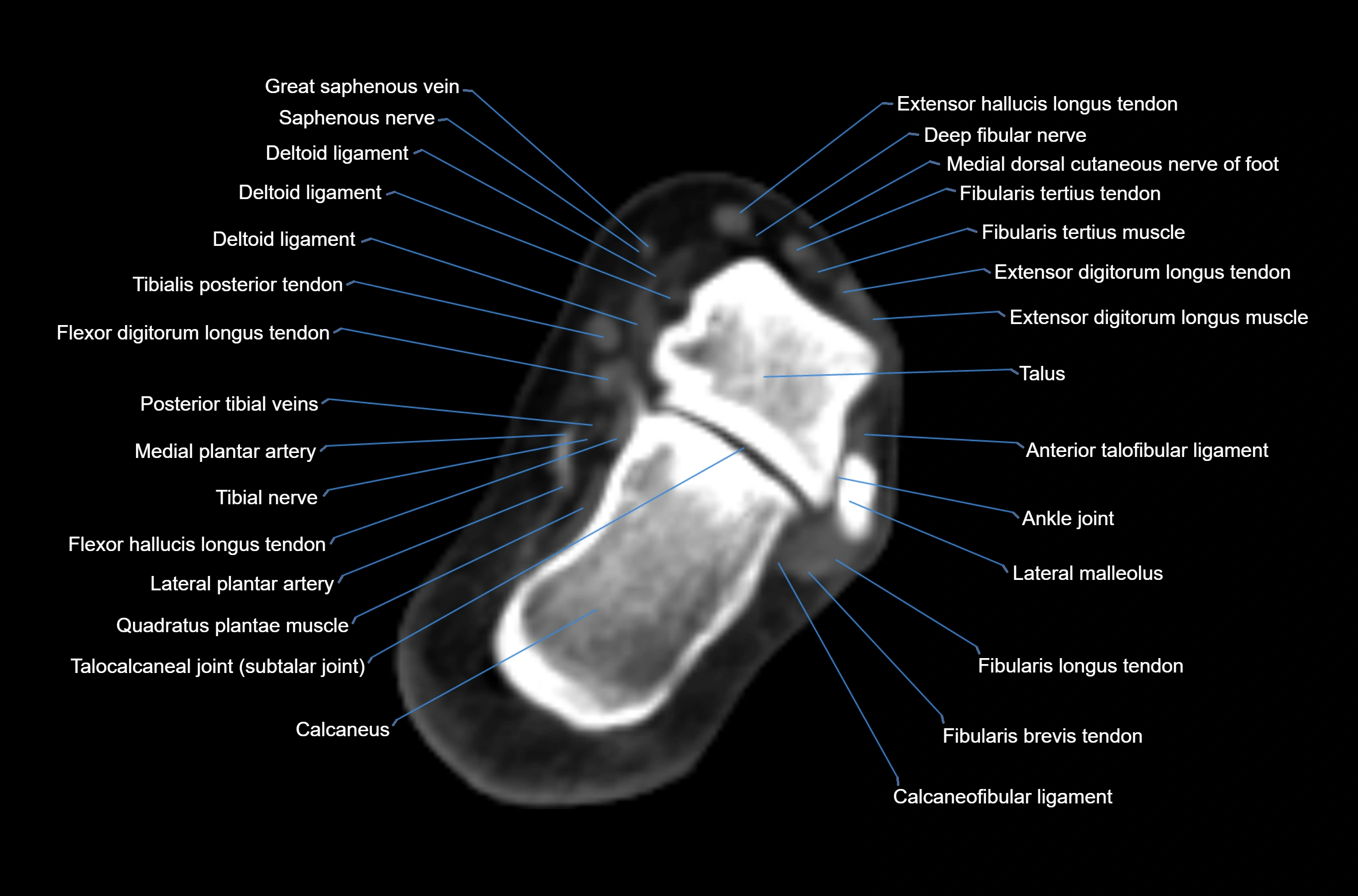 CT Ankle axial cross sectional anatomy labelled image -00035.webp